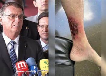 Se decompondo vivo – Carlos Bolsonaro publica foto da perna do pai com erisipela