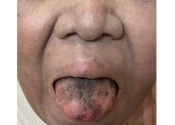 Língua de mulher fica peluda e escura após antibiótico; entenda caso