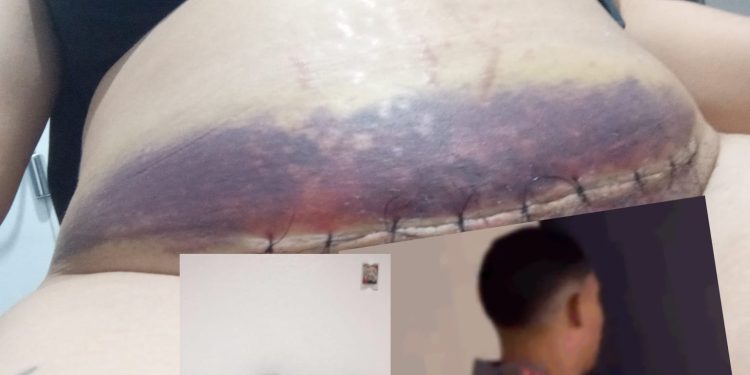 Depois de descaso com Paciente operada de cesariana em Jaguaré, medico e secretária resolvem tomar providências