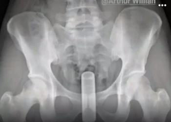 Homem vai coçar as costas com cabo de vassoura e sem querer introduz objeto no ânus em São Mateus